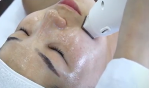 Frakcionális RF bőrfiatalító kezelés arcon – rádiófrekvenciás eljárás közben