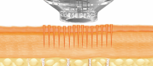 Mikrotűs mezoterápia és elektroporáció hatóanyagbevitelének szemléltetése a bőr rétegeiben